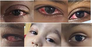 Eye care consultation at Global Eye Hospital